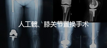人工髖、膝關節置換手術
